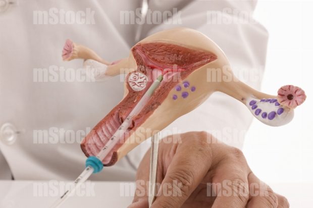 Dispositivo Intrauterino