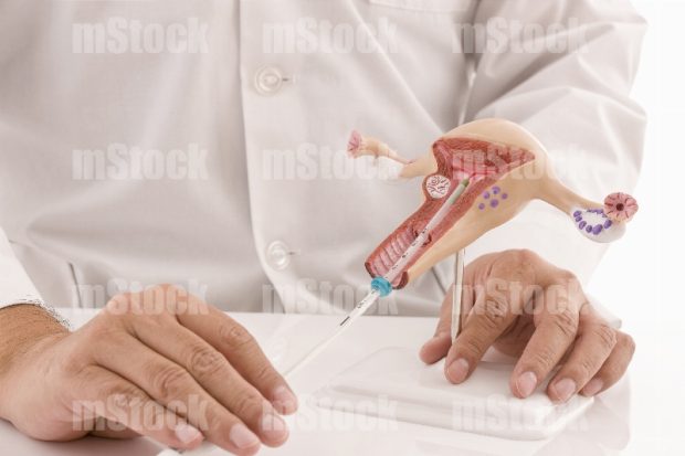 Diu Dispositivo Intrauterino