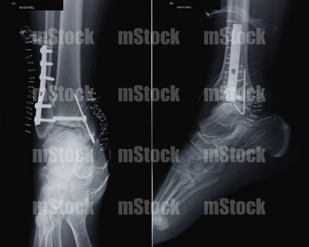 Fijación onterna con Placa y Tornillos en Peroné