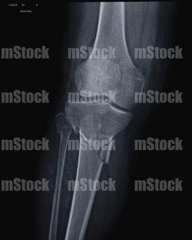 Fractura de Tibia y Perone