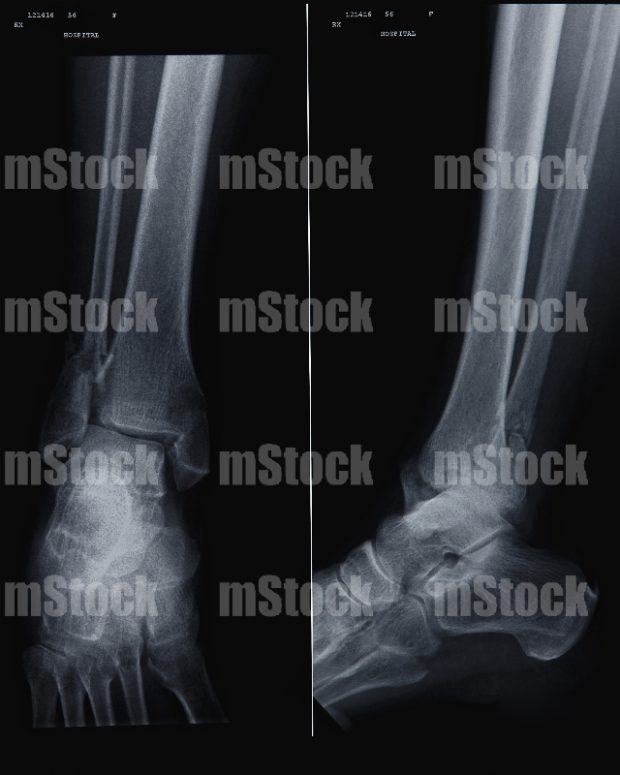 Fractura distal de Peroné