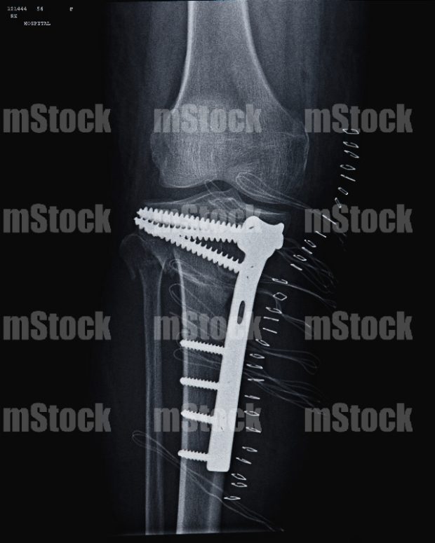 Reparación de Fractura con Placa y Tornillos